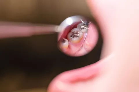 Črne zalivke, opustitev amalgama / Foto: Nik Bertoncelj